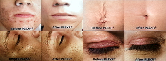 Other skin blemishes