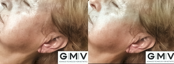 Pigment correction
