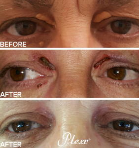xanthelasma